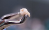 Главные вопросы про удаление зубов мудрости 